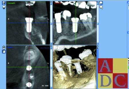 36 with implant.pdf.jpg